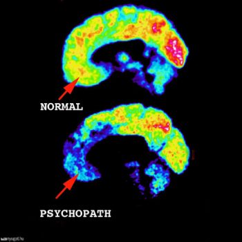 MRI felvétel az agyról